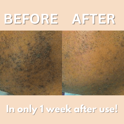 SilkFluence Clear Touch – Ingrown Hair & Dark Spot Treatment Roller
